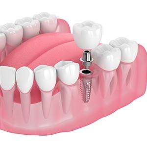 Illustration of a single dental implant