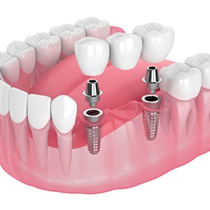 Illustration of an implant bridge