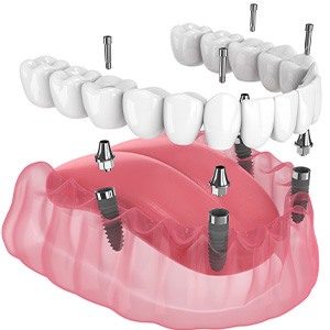 Illustration of an implant denture