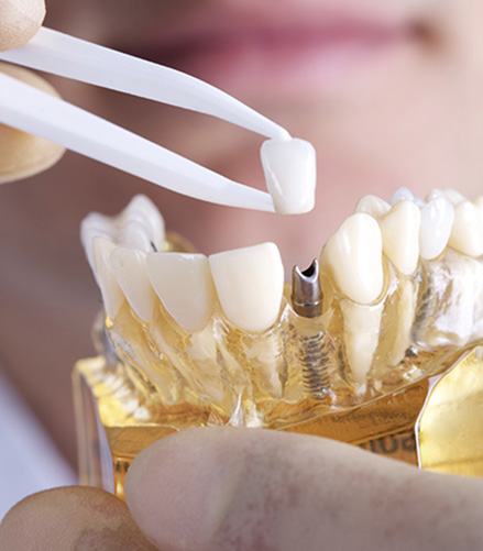 Dentist showing how dental implants work in Independence 