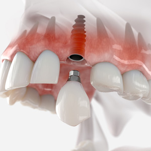 Digital image of a single dental implant 