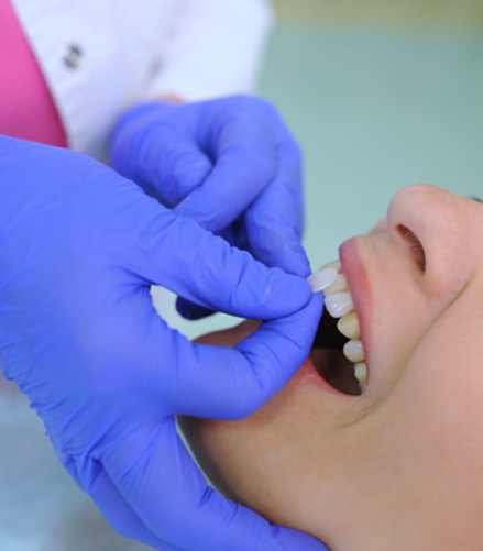 A dentist placing veneers on a woman’s teeth