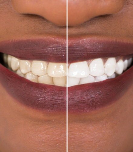 Patient's smile before and after teeth whitening